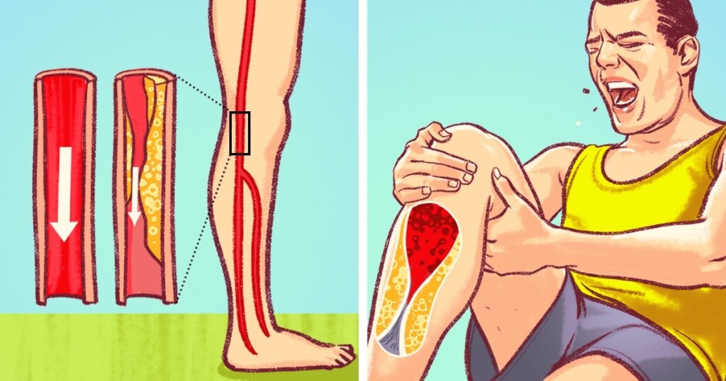 7 Warning Signs You Have Blocked Arteries Explained